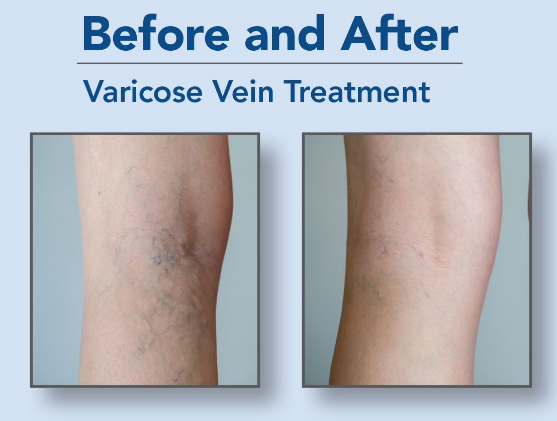 Can Spider Veins Become Varicose Veins?  Vein Center in Walnut Creek,  Brentwood, and Oakland